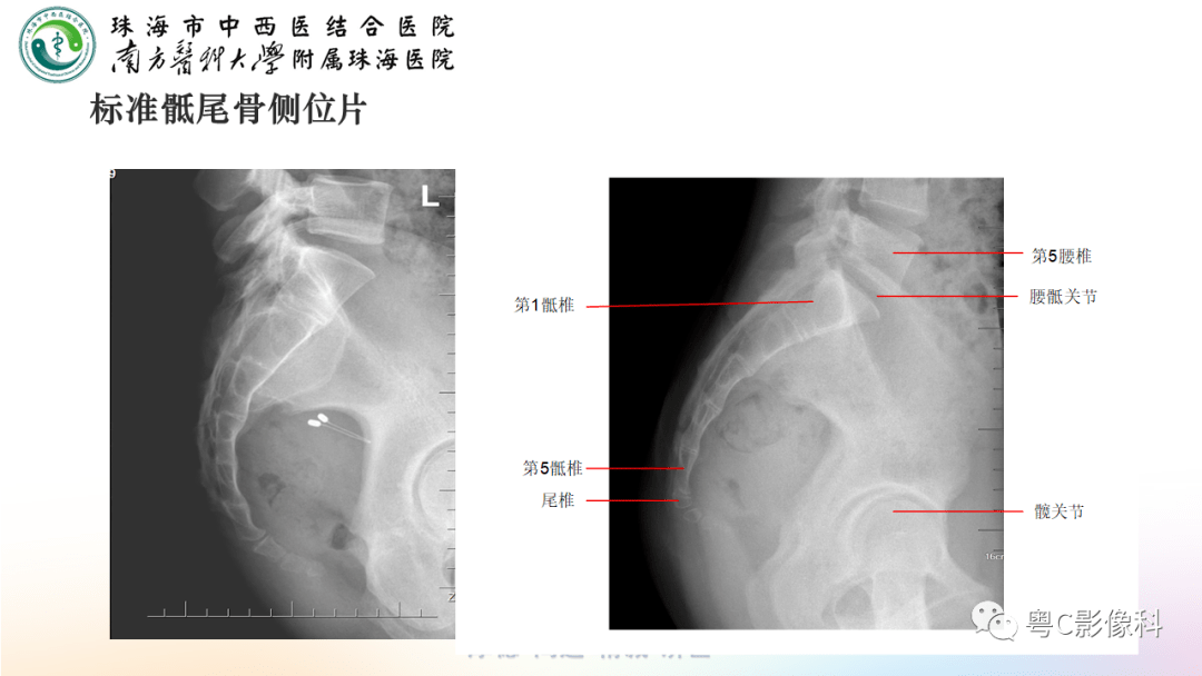 尾骨(尾骨疼痛怎么办)